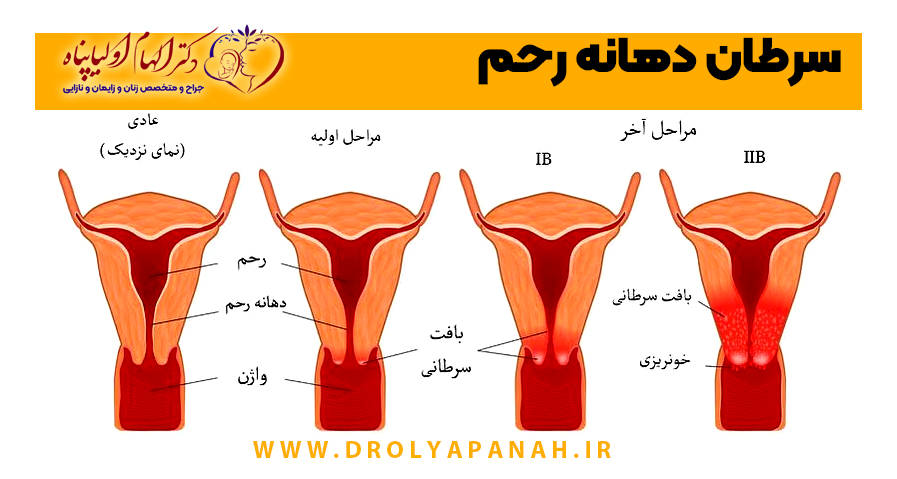 سرطان رحم,درمان سرطان رحم اصفهان,بهترین متخصص زنان و زایمان اصفهان,پیشگیری از سرطان رحم